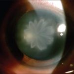 Rosette-Shaped Cataract