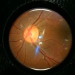 Retinal imaging by your smartphone