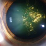 Christmas tree cataract