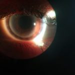 smartphone slit-lamp photography