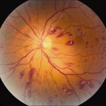 Roth Spots