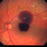 Macroaneurysm