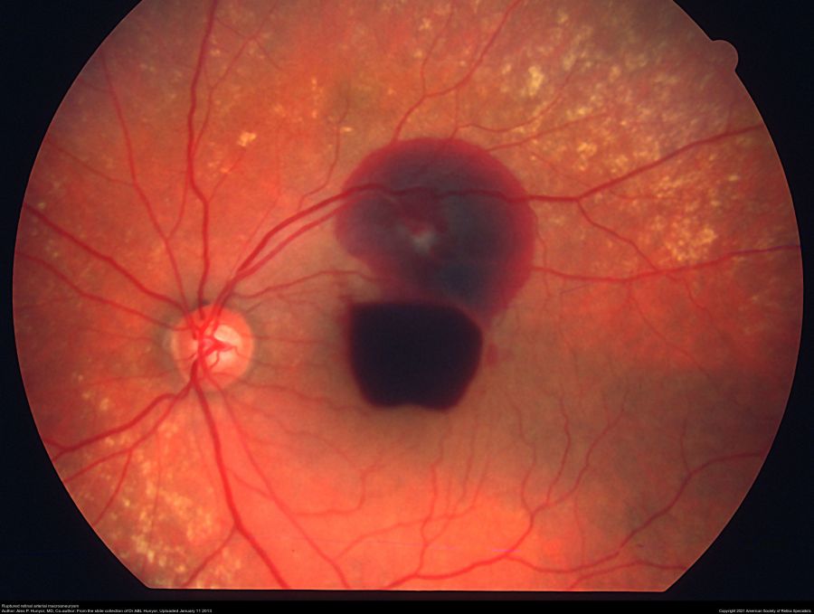 Macroaneurysm
