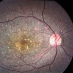 Bietti Crystalline Dystrophy
