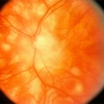 Birdshot Retinochoroidopathy