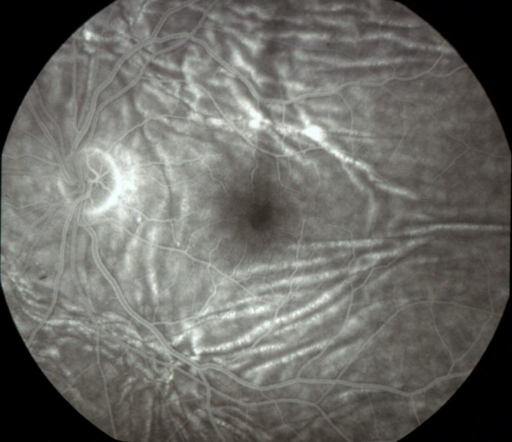 Choroidal Folds Case Report Disease And Management Ophthalmology