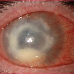 Acanthamoeba Keratitis