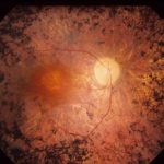 Retinitis_Pigmentosa
