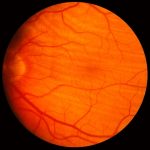 Choroidal Folds