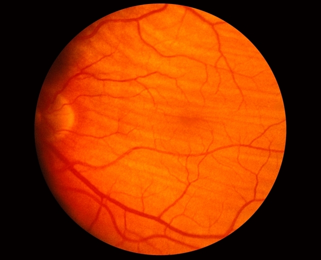 Choroidal Folds, case report, disease and management