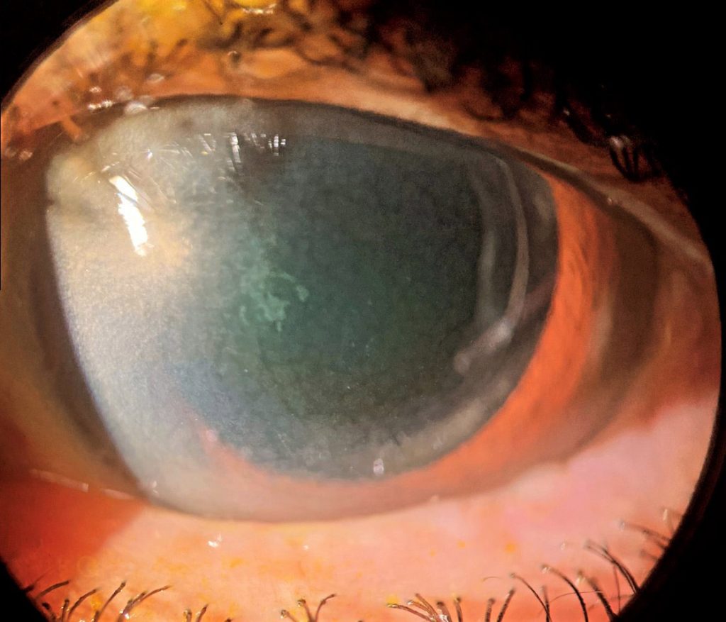 High-magnification slit-lamp view of crocodile shagreen with mosaic stromal opacities and clear intervening zones
