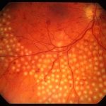 Diabetic retinopathy