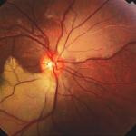 Branch Retinal Artery Occlusion