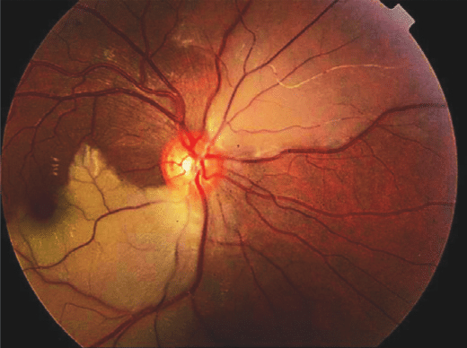 Branch Retinal Artery Occlusion