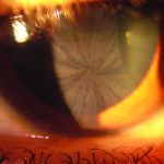 Cornea Verticillate
