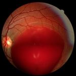 Valsalva Retinopathy