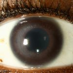 Cogan’s syndrome