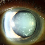 Cerulean Cataract