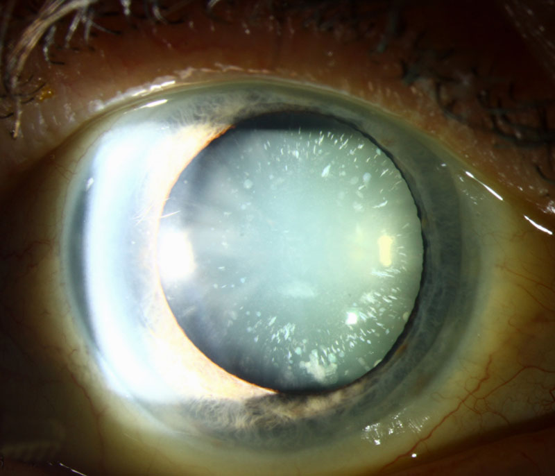 Cerulean Cataract