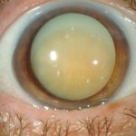 Morgagnian Cataract