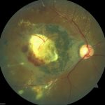 Coats Disease