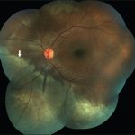 Commotio Retinae
