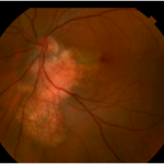 Choroidal osteoma