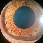 Plateau iris
