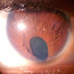 coloboma