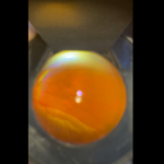 Retina Detachment