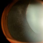 Ectopia Lentis