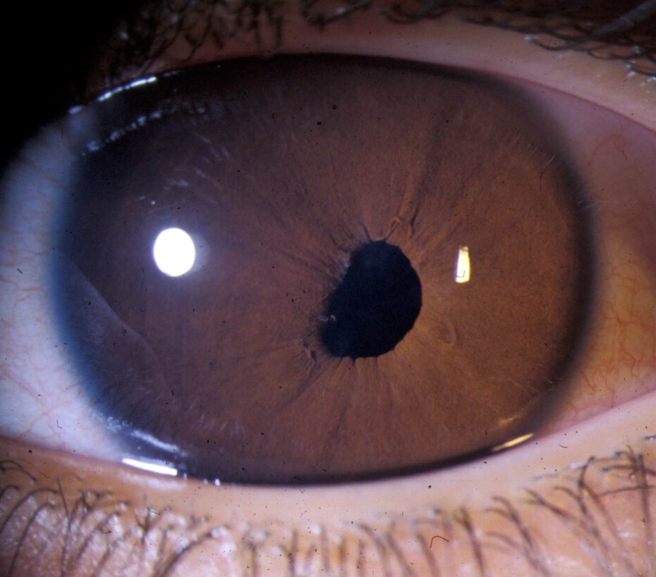 bilateral ectopic pupil