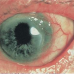 Mooren's Ulcer