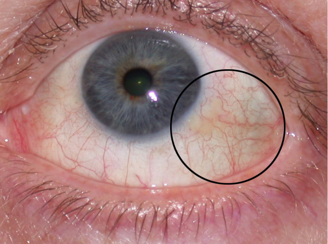 Pinguecula (Yellow Bump on Eyeball): Diagnosis, Causes & Treatment
