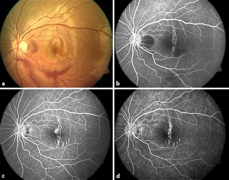 Choroidal Rupture