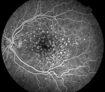 Basal Laminar Drusen