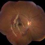 Choroidal Rupture
