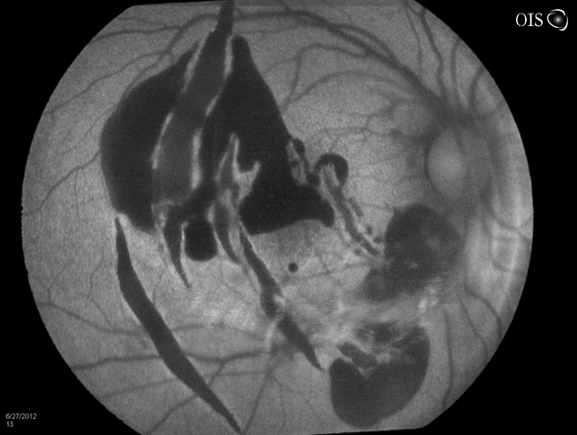 Choroidal Rupture