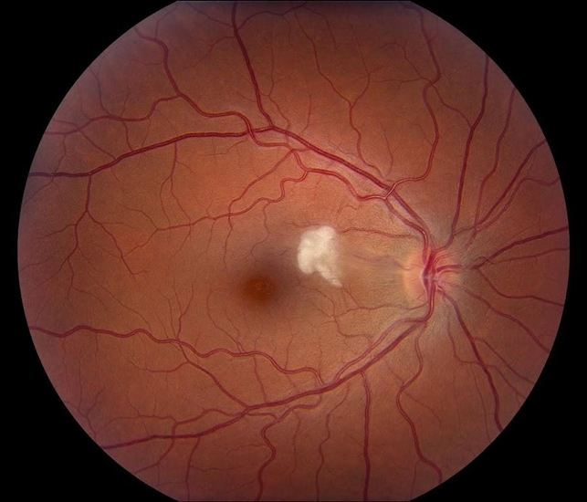 Cotton Wool Spots disease entity and management