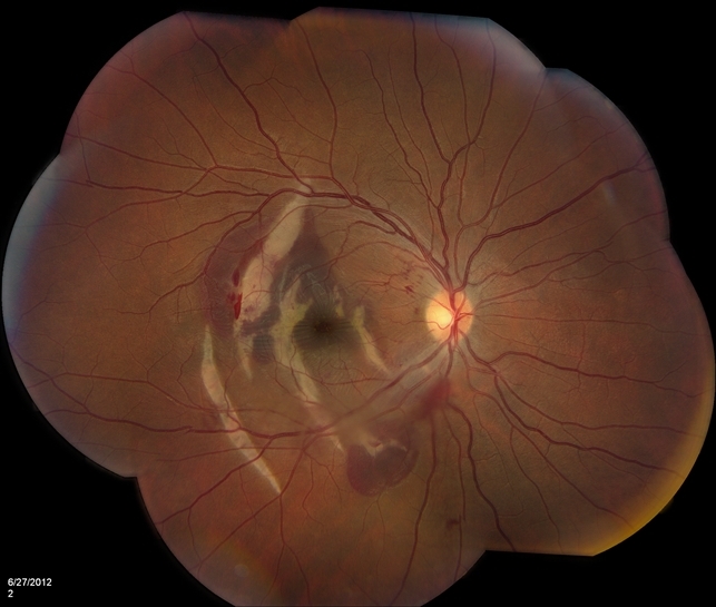 Choroidal Rupture: case study, complications and how to deal with