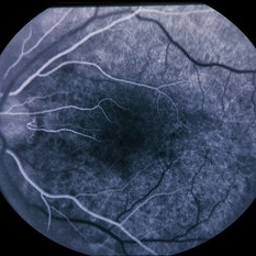 acute macular neuroretinopathy