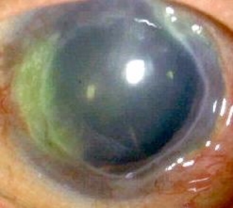 Mooren's Ulcer