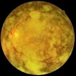 Asteroid Hyalosis