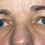Adie tonic pupil, Adie’s Syndrome, Holmes-Adie Syndrome