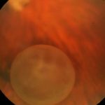 Vitreous Cysts
