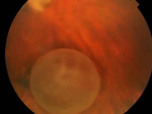 Vitreous Cysts in a 10-years-old child