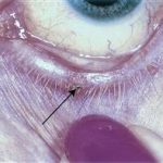 Actinic Keratosis