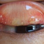 Conjunctival Concretions