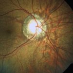Angioid Streaks