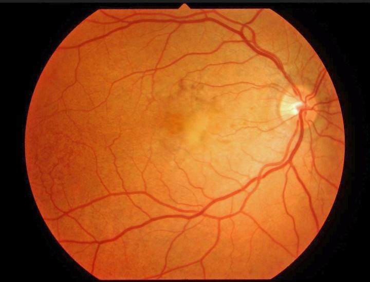 Pseudoxanthoma Elasticum: Effects on the eye